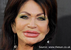 Age-inappropriate lip augmentation