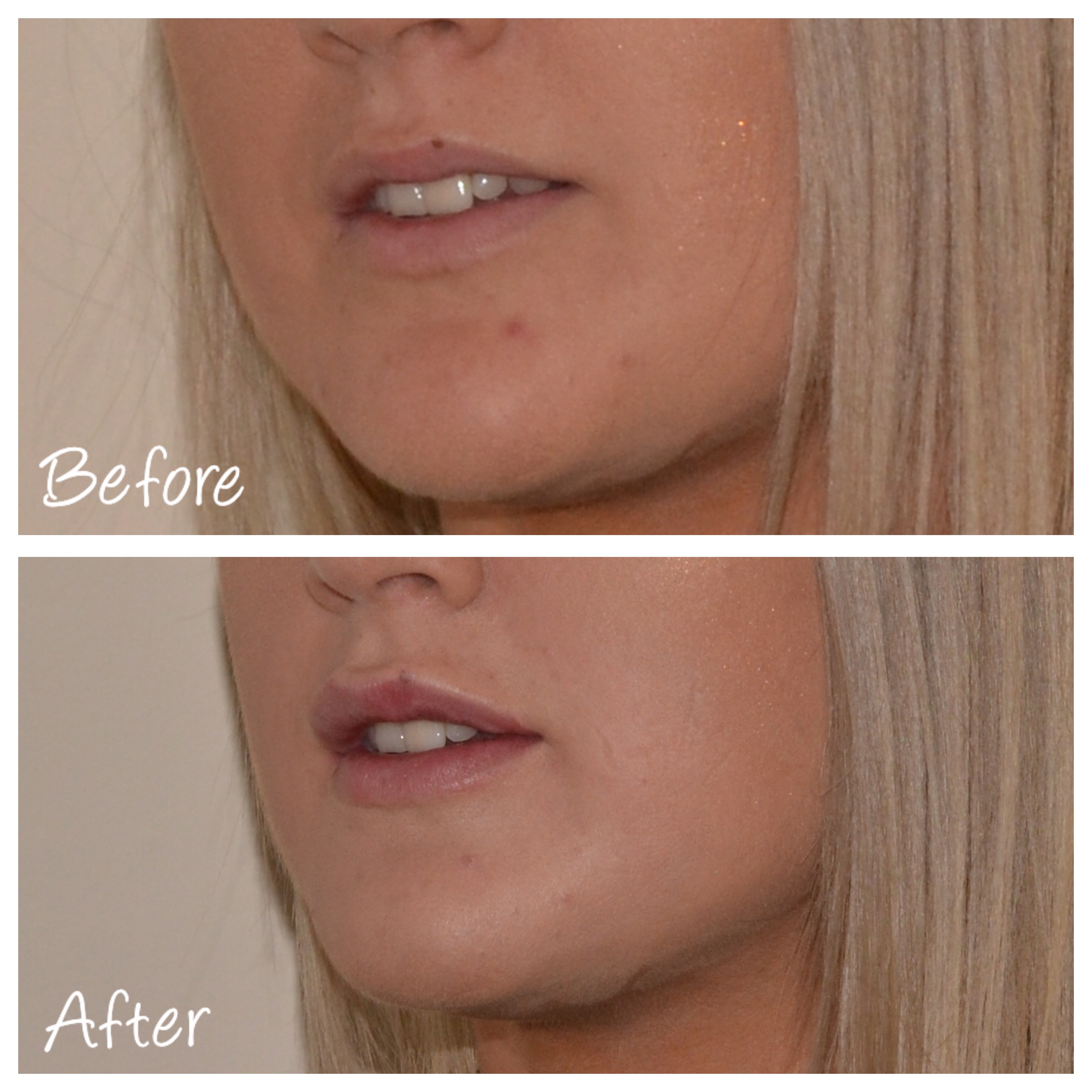 Before And After Photo Lip Filler 2 