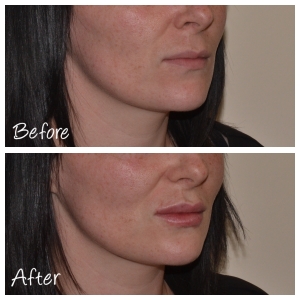 Before and After Lip Augmentation: Advanced Botox and Dermal Filler Training