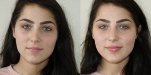 before and after lip filler