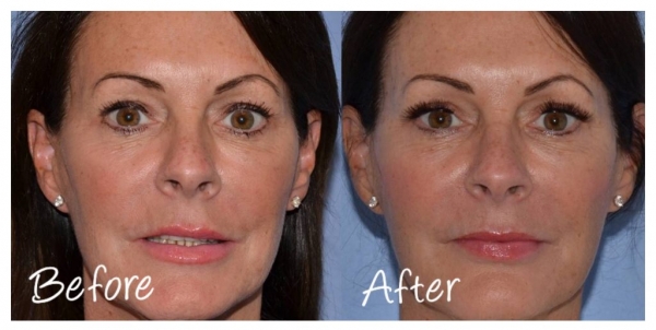 Practitioner Benefits of Non-Surgical Facelift Treatment - Cosmetic Courses