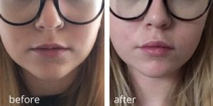 before and after lip fillers (1)