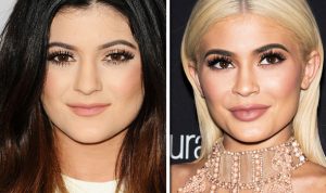 kylie jenner before and after lip filler experience
