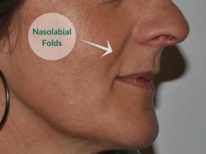 nasolabial folds