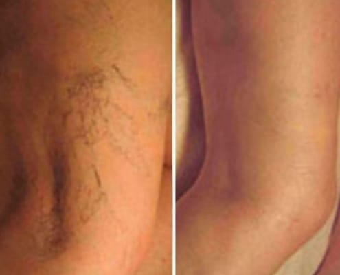 leg thread vein removal before and after cosmetic courses