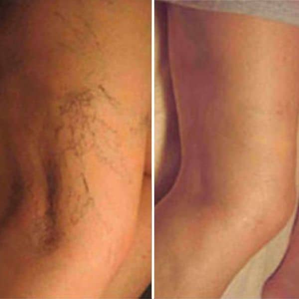 Leg Spider Veins & Thread Vein Removal