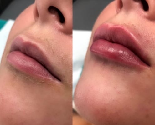 lip filler treatments cosmetic courses (1)