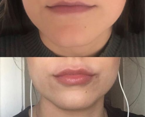 lip filler treatments cosmetic courses (2)