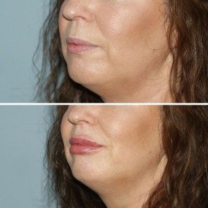 lip filler treatments cosmetic courses (3)
