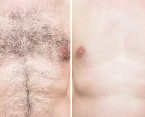 chest laser hair removal