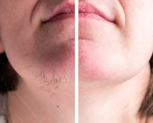 chin laser hair removal