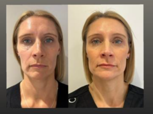 HArmonyCa Treatment - A Dual-Effect Hybrid Injectable
