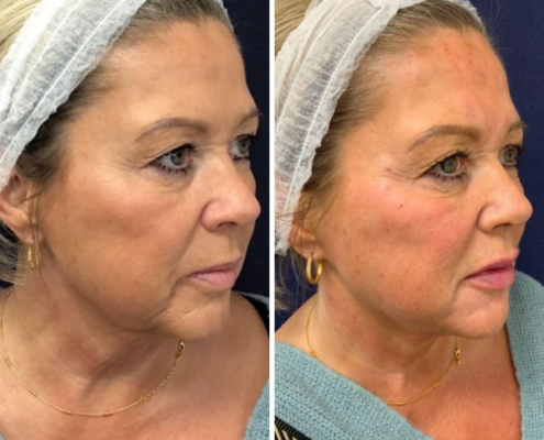 Non Surgical Face Lift Before & After 8