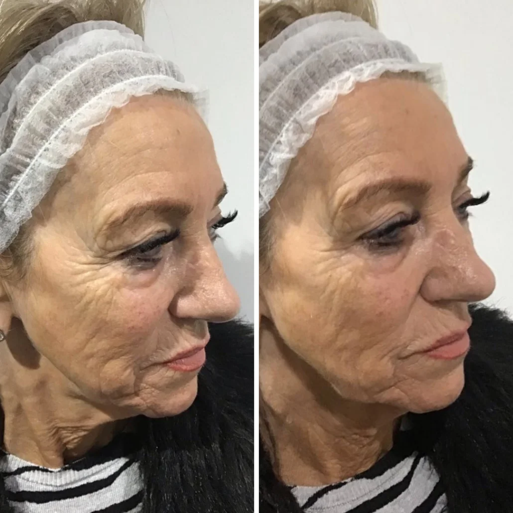 Non Surgical Facelift Treatment for Models - Cosmetic Courses