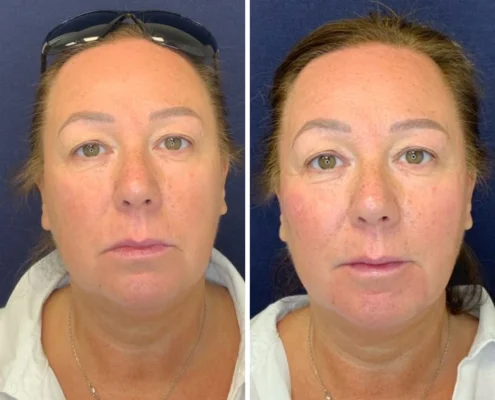 Non Surgical Face Lift Before & After 4